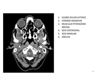 86
1. GLOBO OULAR (VITRIO)
2. FORAME MAGNUM
3. MUSCULO PITERIGÓIDE
MEDIAL
4. SEIO ESFENOIDAL
5. SEIO MAXILAR
6. ORELHA
1
2
3
4
5
6
 
