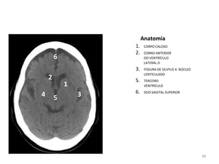 88
Anatomia
1. CORPO CALOSO
2. CORNO ANTERIOR
DO VENTRÍCULO
LATERAL D
3. FISSURA DE SILVYUS 4. NÚCLEO
LENTICULADO
5. TERCEIRO
VENTRÍCULO
6. SEIO SAGITAL SUPERIOR
1
2
3
4 5
6
 
