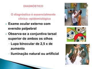 DIAGNÓSTICO
O diagnóstico é essencialmente
clínico- epidemiológico
 Exame ocular externo com
eversão palpebral
 Observa-se a conjuntiva tarsal
superior de ambos os olhos
◦ Lupa binocular de 2,5 x de
aumento
◦ Iluminação natural ou artificial
 