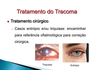 Tratamento do Tracoma
 Tratamento cirúrgico
– Casos entrópio e/ou triquíase: encaminhar
para referência oftalmológica para correção
cirúrgica.
Entrópio
Triquíase
 