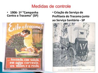 • 1906- 1ª “Campanha
Contra o Tracoma” (SP)
Medidas de controle
• Criação do Serviço de
Profilaxia do Tracoma junto
ao Serviço Sanitário - SP
 