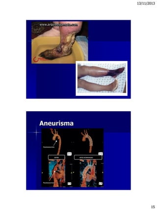 13/11/2013
15
Aneurisma
 