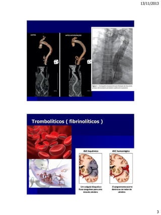 13/11/2013
3
Trombolíticos ( fibrinolíticos )
 