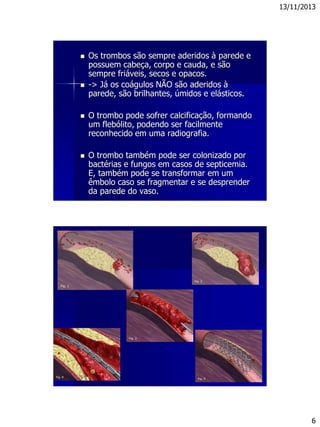 13/11/2013
6
 Os trombos são sempre aderidos à parede e
possuem cabeça, corpo e cauda, e são
sempre friáveis, secos e opacos.
 -> Já os coágulos NÃO são aderidos à
parede, são brilhantes, úmidos e elásticos.
 O trombo pode sofrer calcificação, formando
um flebólito, podendo ser facilmente
reconhecido em uma radiografia.
 O trombo também pode ser colonizado por
bactérias e fungos em casos de septicemia.
E, também pode se transformar em um
êmbolo caso se fragmentar e se desprender
da parede do vaso.
 