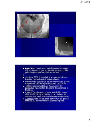 13/11/2013
7
 EMBOLIA: Consiste na existência de um corpo
sólido, líquido ou gasoso (êmbolo) transportado
pelo sangue capaz de obstruir um vaso.

 - Mais de 90% dos êmbolos se originam de um
trombo, chamados de tromboembolia.
 O trombo se desprende da parede do vaso e seus
fragmentos são transportados pela circulação.
 -Sólido: São formados por fragmentos de
partículas, fragmentos de placas de ateromas, e
trombos.
 -Líquida (gordurosa): presença de lipídeos que
obstruem a microcirculação, pode também ser
causado por medicamentos viscosos endovenoso.
 -Gasosa: pode ser causado por bolhas de gás na
seringa, ou por contraturas durante o parto.
 