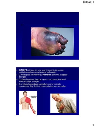 13/11/2013
9
 INFARTO: consiste em uma aréa circunscrita de necrose
tecidual causada por uma isquemia prolongada.
 O infarto pode ser branco ou vermelho, conforme o aspecto
do órgão.
 O infarto Isquêmico (branco): ocorre uma obstrução arterial
antes de chegar no órgão.
 Já o infarto Hemorrágico (vermelho): ocorre no órgão
propriamente dito, devido a hemorragia tem a cor vermelha.
 