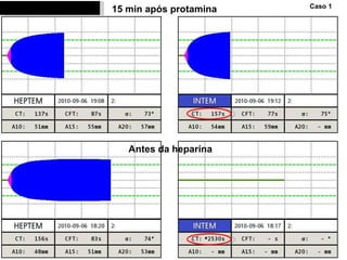 15 min após protamina Antes da heparina Caso 1 