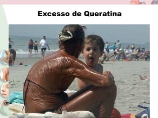 Excesso de Queratina
 