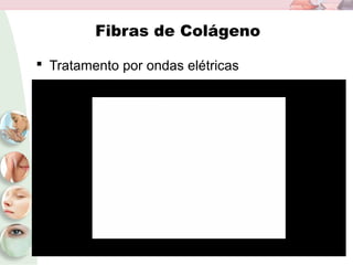 Fibras de Colágeno
 Tratamento por ondas elétricas
 