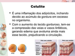 Celulite
 É uma inflamação dos adipócitos, inchando
devido ao acúmulo da gordura em excesso
no organismo.
 Com o aumento do tecido gorduroso, tem-se
a compressão das veias e vasos linfáticos,
gerando edema que avoluma ainda mais
esse tecido, prejudicando a circulação.
 