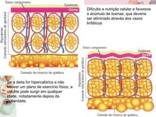 Dificulta a nutrição celular e favorece
o acúmulo de toxinas, que deveria
ser eliminado através dos vasos
linfáticos
Se a dieta for hipercalórica e não
houver um plano de exercício físico, a
celulite pode surgir em qualquer
idade, notadamente depois da
puberdade.
 