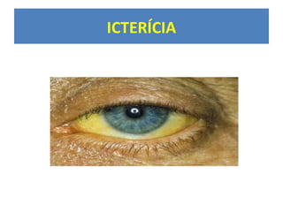 ICTERÍCIA
 