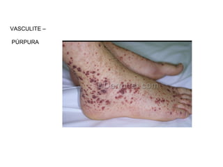 VASCULITE –
PÚRPURA
 