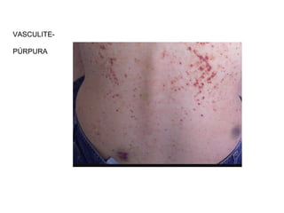 VASCULITE-
PÚRPURA
 