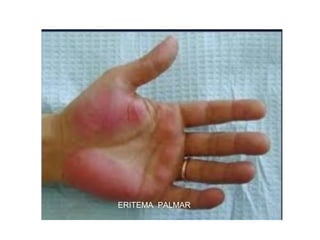 ERITEMA PALMAR
 