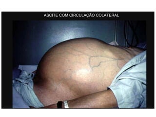 ASCITE COM CIRCULAÇÃO COLATERAL
 