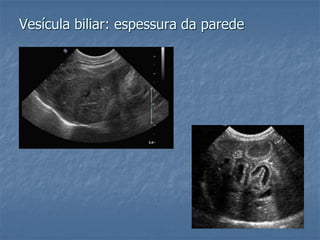 Vesícula biliar: espessura da parede
 