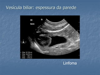 Vesícula biliar: espessura da parede
Linfoma
 