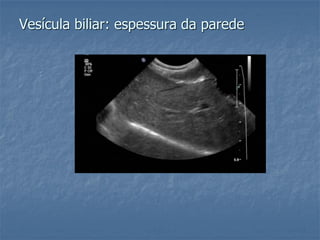 Vesícula biliar: espessura da parede
 