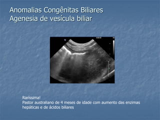 Anomalias Congênitas Biliares
Agenesia de vesícula biliar
Raríssima!
Pastor australiano de 4 meses de idade com aumento das enzimas
hepáticas e de ácidos biliares
 