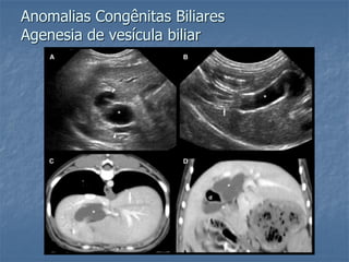 Anomalias Congênitas Biliares
Agenesia de vesícula biliar
 