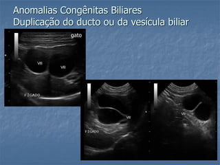 Anomalias Congênitas Biliares
Duplicação do ducto ou da vesícula biliar
gato
 