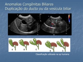 Anomalias Congênitas Biliares
Duplicação do ducto ou da vesícula biliar
Classificação utilizada na sp humana
 