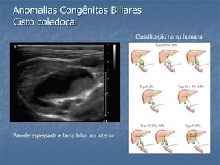 Anomalias Congênitas Biliares
Cisto coledocal
Classificação na sp humana
Parede espessada e lama biliar no interior
 