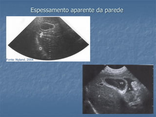 Espessamento aparente da parede
Fonte: Nyland, 2004
 