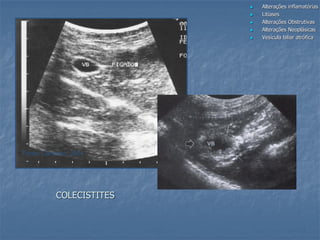 COLECISTITES
Fonte: Carvalho, 2004
 Alterações inflamatórias
 Litíases
 Alterações Obstrutivas
 Alterações Neoplásicas
 Vesícula biliar atrófica
 