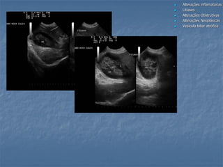 Alterações inflamatórias
 Litíases
 Alterações Obstrutivas
 Alterações Neoplásicas
 Vesícula biliar atrófica
 