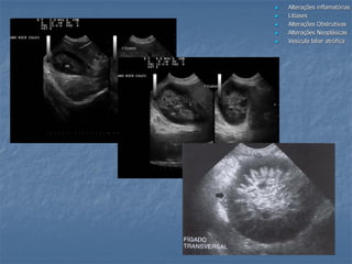  Alterações inflamatórias
 Litíases
 Alterações Obstrutivas
 Alterações Neoplásicas
 Vesícula biliar atrófica
 