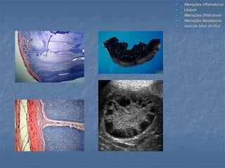  Alterações inflamatórias
 Litíases
 Alterações Obstrutivas
 Alterações Neoplásicas
 Vesícula biliar atrófica
 