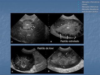  Alterações inflamatórias
 Litíases
 Alterações Obstrutivas
 Alterações Neoplásicas
 Vesícula biliar atrófica
Padrão estrelado
Padrão de kiwi
 