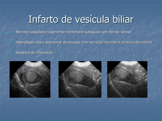Infarto de vesícula biliar
 Necrose coagulativa segmentar transmural subaguda com fibrose serosa
 Hiperplasia cística segmentar da mucosa com secreção mucoide e proteica abundante
 Ausência de inflamação
 