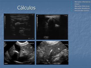  Alterações inflamatórias
 Litíases
 Alterações Obstrutivas
 Alterações Neoplásicas
 Vesícula biliar atrófica
Cálculos
 