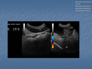 Alterações inflamatórias
 Litíases
 Alterações Obstrutivas
 Alterações Neoplásicas
 Vesícula biliar atrófica
 