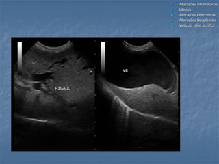  Alterações inflamatórias
 Litíases
 Alterações Obstrutivas
 Alterações Neoplásicas
 Vesícula biliar atrófica
 