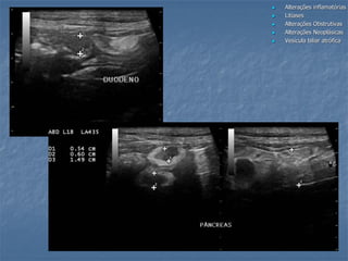  Alterações inflamatórias
 Litíases
 Alterações Obstrutivas
 Alterações Neoplásicas
 Vesícula biliar atrófica
 