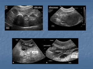 cálculos abscesso
DBC
gordura
gordura
pancreatite
 