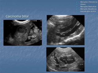  Alterações inflamatórias
 Litíases
 Alterações Obstrutivas
 Alterações Neoplásicas
 Vesícula biliar atrófica
Carcinoma biliar
 