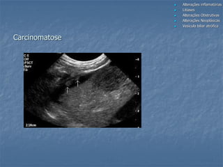 Carcinomatose
 Alterações inflamatórias
 Litíases
 Alterações Obstrutivas
 Alterações Neoplásicas
 Vesícula biliar atrófica
 