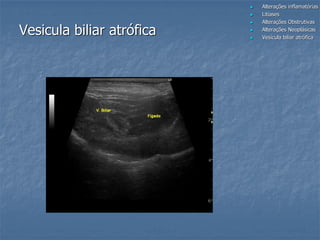  Alterações inflamatórias
 Litíases
 Alterações Obstrutivas
 Alterações Neoplásicas
 Vesícula biliar atrófica
Vesicula biliar atrófica
 
