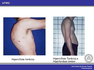 Ana Paula de Sousa Paixão Fisioterapêuta UFMG Hipercifose torácica Hipercifose Torácica e Hiperlordose lombar 