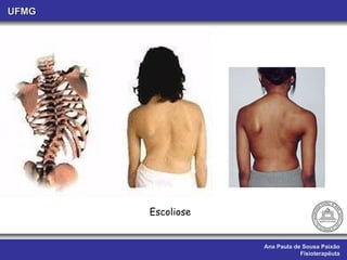 Ana Paula de Sousa Paixão Fisioterapêuta UFMG Escoliose 