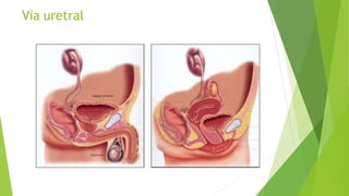 Via uretral
 