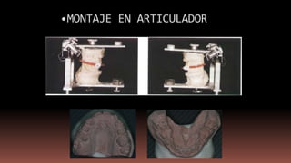 •MONTAJE EN ARTICULADOR
 