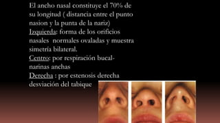 El ancho nasal constituye el 70% de
su longitud ( distancia entre el punto
nasion y la punta de la nariz)
Izquierda: forma de los orificios
nasales normales ovaladas y muestra
simetría bilateral.
Centro: por respiración bucal-
narinas anchas
Derecha : por estenosis derecha
desviación del tabique
 