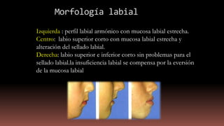 Morfología labial
Izquierda : perfil labial armónico con mucosa labial estrecha.
Centro: labio superior corto con mucosa labial estrecha y
alteración del sellado labial.
Derecha: labio superior e inferior corto sin problemas para el
sellado labial.la insuficiencia labial se compensa por la eversión
de la mucosa labial
 