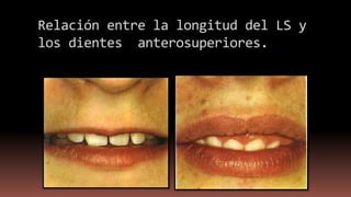 Relación entre la longitud del LS y
los dientes anterosuperiores.
 